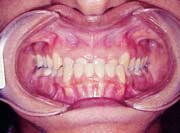 Ortodontia antes
